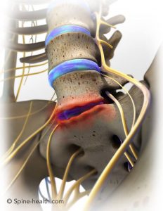 Herniated (degenerative) Discs can be safely treated with decompression therapy combined with chiropractic care