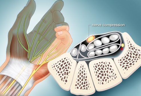 chiropractor-woodridge-il-herniated-disc-treatment