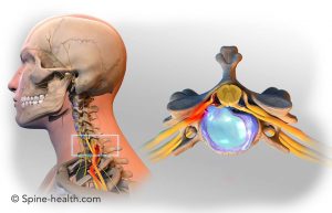 chronic pain management in the neck and shoulder